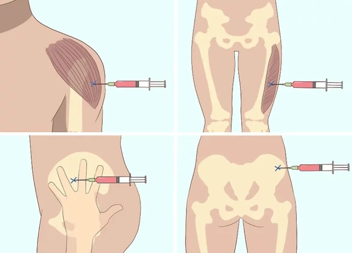 Болят ягодицы от уколов. Правильно поставить укол внутримышечно. Как правильно сделать укол внутримышечно. Укол внутримышечно в ягодицу. Подкожно внутрикожно внутримышечно.