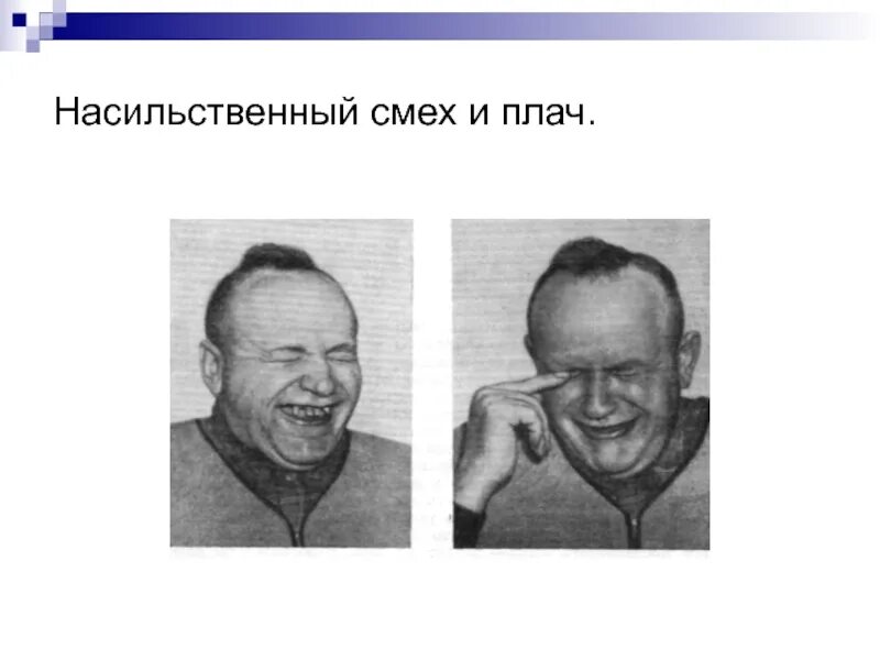 Смех как реакция. Насильственный смех и плач. насильственный смех неврология. псевдобульбарный паралич. насильственный плач псевдобульбарный синдром.