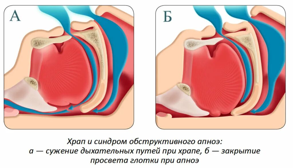 Лечение синдрома обструктивного апноэ. Апноэ. обструктивное сонное апноэ. синдром обструктивного апноэ.