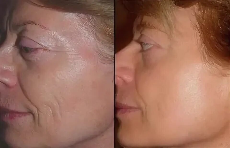 Инъекции коллагена отзывы
