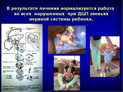 Причины дцп у детей