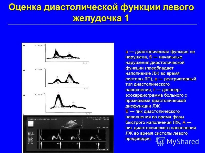 Признаки диастолической дисфункции