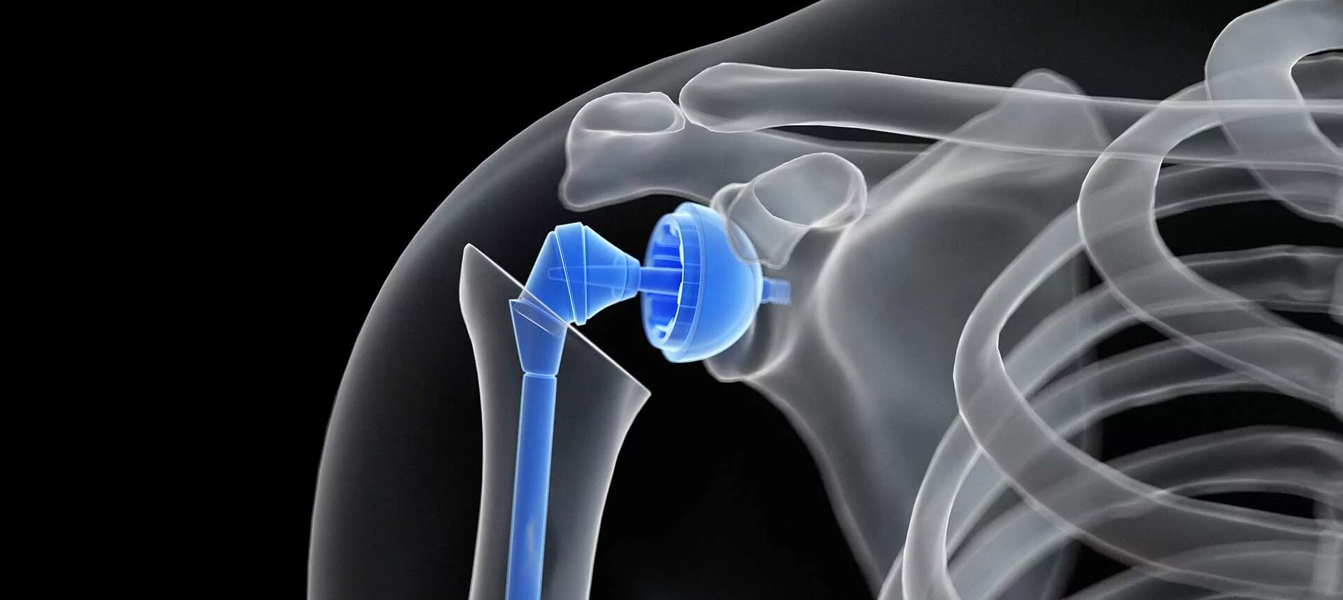 Эндопротез плечевого сустава Тотальный реверсивный. Тотальное эндопротезирование плечевого сустава. Эндопротезирование плечевого сустава рентген. Спейсер плечевого сустава. Операция по замене плечевого сустава