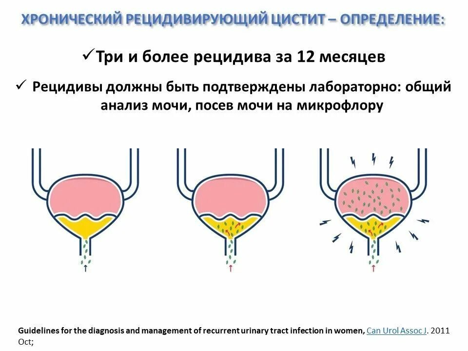 Как понять что у тебя цистит симптомы. Проявление цистита. рецидивирующий цистит.
