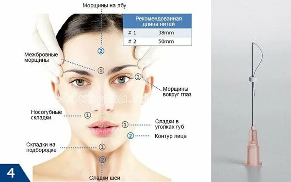 Канюлей лицо до и после Восстановление объемов Academie