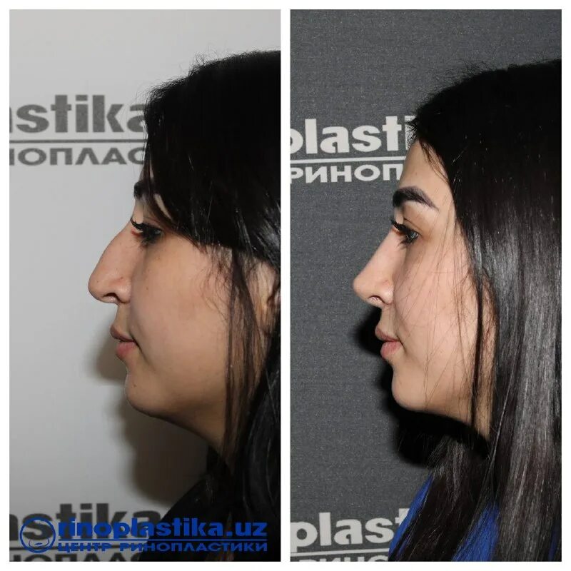 центр ринопластики. барсаков максим пластический хирург. дамас рино. клиника хромова ринопластика. ринопластика или риносептопластика.