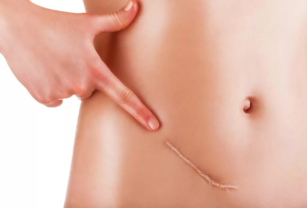 Как избавиться от пупка. Жирок на боках. Как избавиться от пупка. Как избавиться от пупка. Жировые складки на боках.