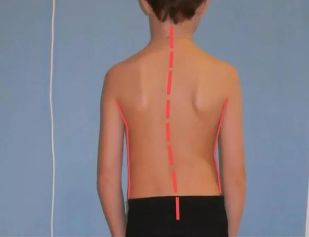 Сколиоз и сколиотическая болезнь. Искривление позвоночника у подростка. Кривой позвоночник у ребенка. Искривление позвоночника сутулость. Искривления позвоночника у детей школьного возраста.