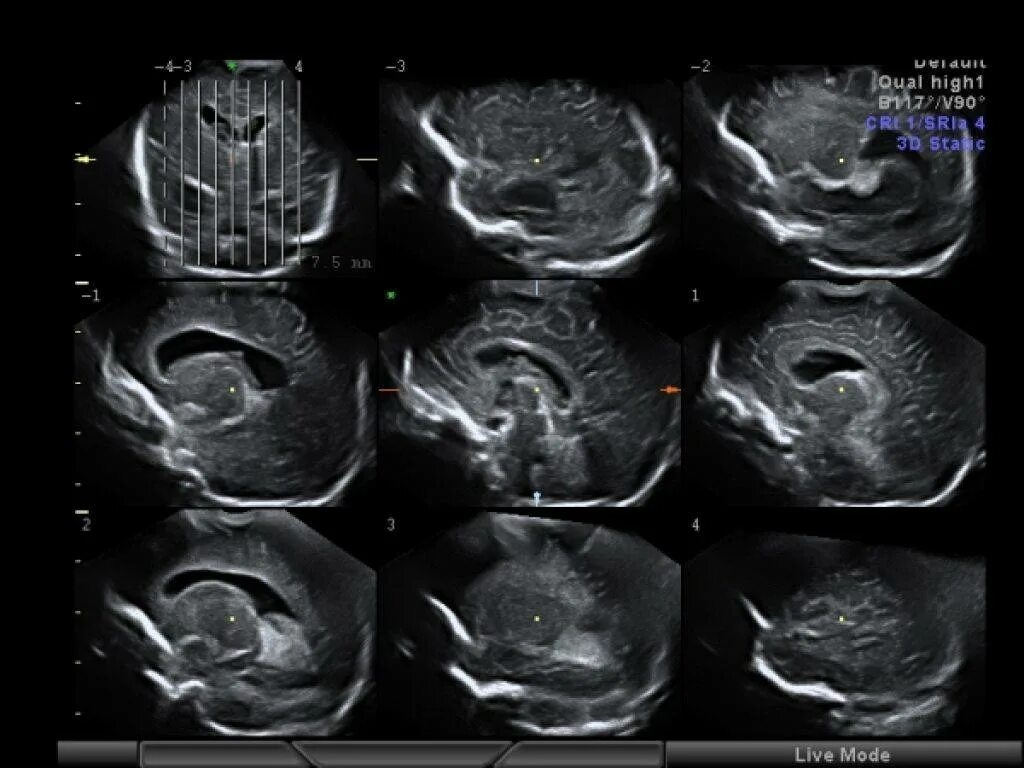 НСГ УЗИ головного мозга. Ультразвуковая анатомия головного мозга новорожденных. Нейросонография головного мозга грудничка норма. УЗИ головного мозга нейросонография. Узи головного мозга как подготовиться