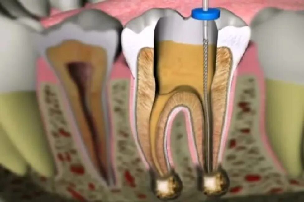 Расширение каналов зубов