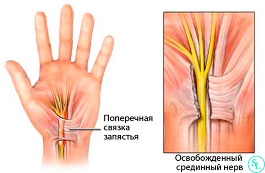 Защемление нерва в запястье. Невропатия локтевого нерва туннельный синдром. кубитальный туннельный синдром локтевого нерва. туннельный синдром карпального канала операция. срединный нерв лучезапястного сустава.