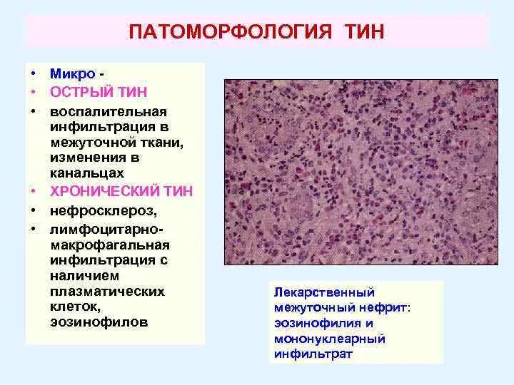 Воспалительный инфильтрат гистология. Лейкемическая инфильтрация дермы. Мононуклеарнои воспалительная инфильтрация. Инфильтрат полиморфноклеточный микропрепарат.