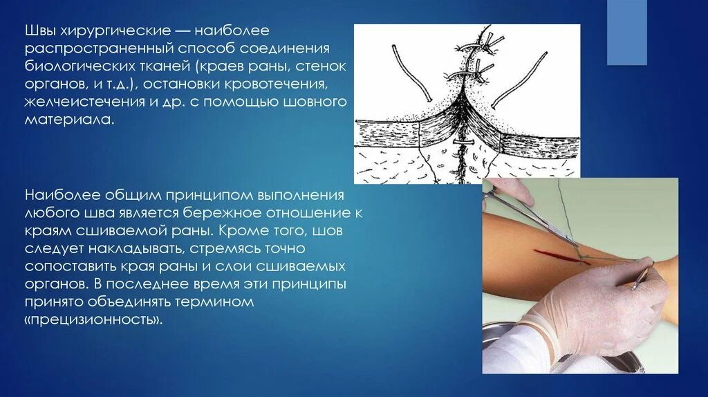 Х образный шов. Непрерывные узловые швы в хирургии. Кожный шов хирургический. Материал для наложения хирургических швов. Наложение хирургического шва.