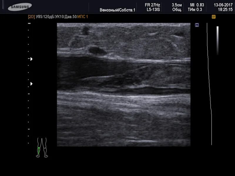 Тромбоз бедренной вены на УЗИ. Артериальный тромбоз на УЗИ. Илеофеморальный венозный тромбоз. Тромбоз сонной артерии УЗИ. Тромбоз без флотации