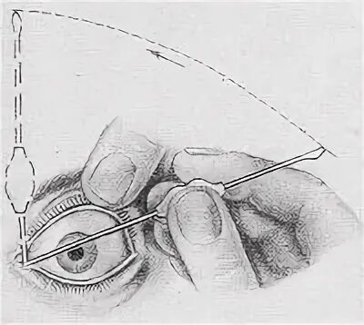 Зондирование слезного канала у детей. Дакриоцистит промывание. Зондирование слезного канала техника. Зондирование слезоотводящих путей.