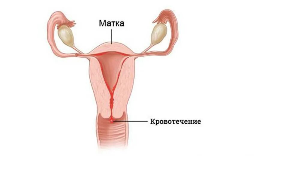 Спираль вмс мирена. Внутриматочная спираль методы контрацептивов. Спираль внутриматочная. Мирена кровотечение после установки. Мирена установка инструкция.