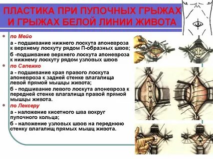 Виды операции грыжи