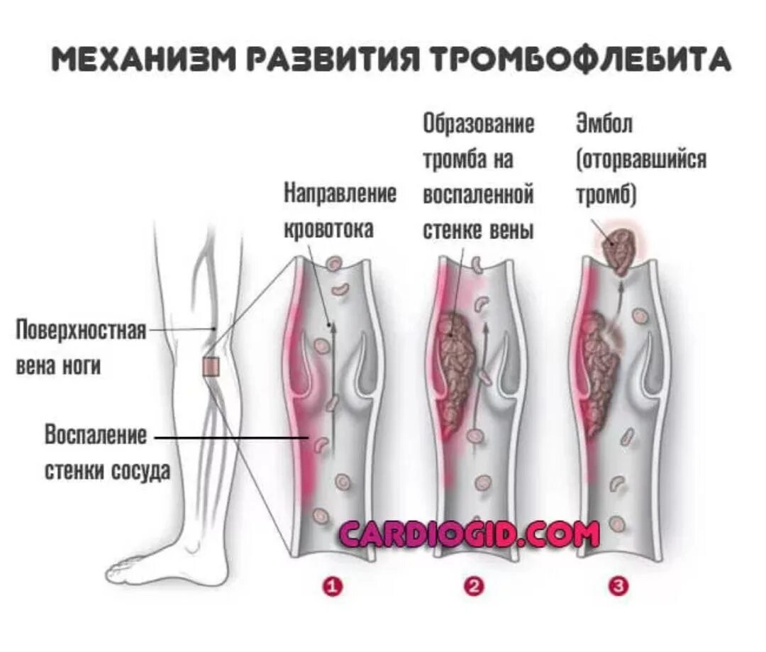 Что такое тромб и как он. Острый тромбофлебит нижних конечностей. тромбоз поверхностных вен голени. тромбофлебит подкожных вен.