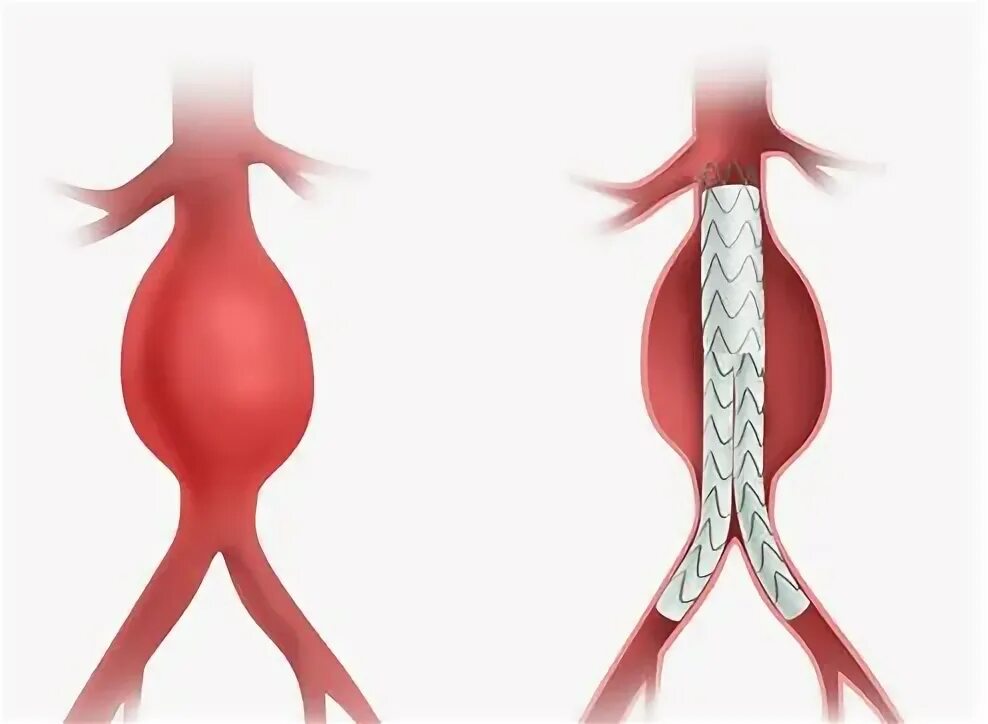 Стентирование аневризмы. Стентирование аневризмы брюшной аорты. Аневризма синуса Вальсальвы. Тажелий форми аневризма голови.
