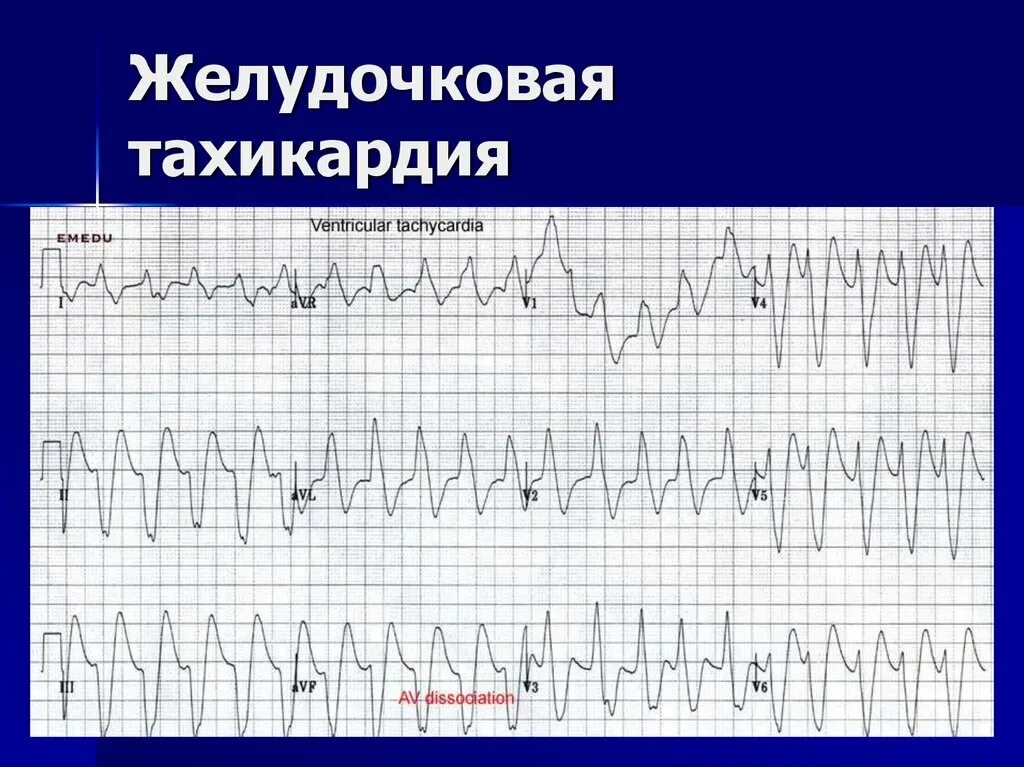 Желудочковая тахикардия на экг. ЭКГ желудочковая тахикардия ЭКГ. Мономорфная желудочковая тахикардия ЭКГ. Пароксизмальная мономорфная желудочковая тахикардия ЭКГ. Пароксизмальной тахикардии желудочковая ЭКГ диагностика.