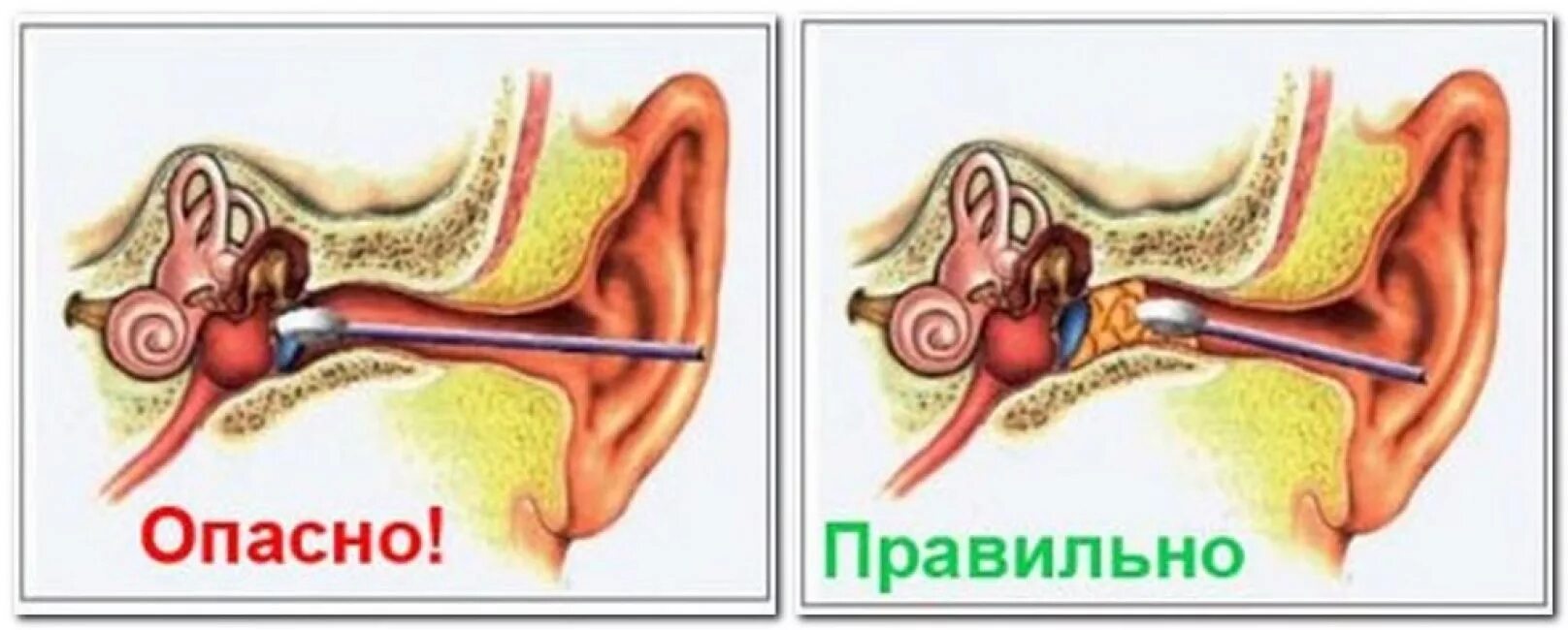 Почему образуются пробки в ушах. Как выглядит ушная пробка.