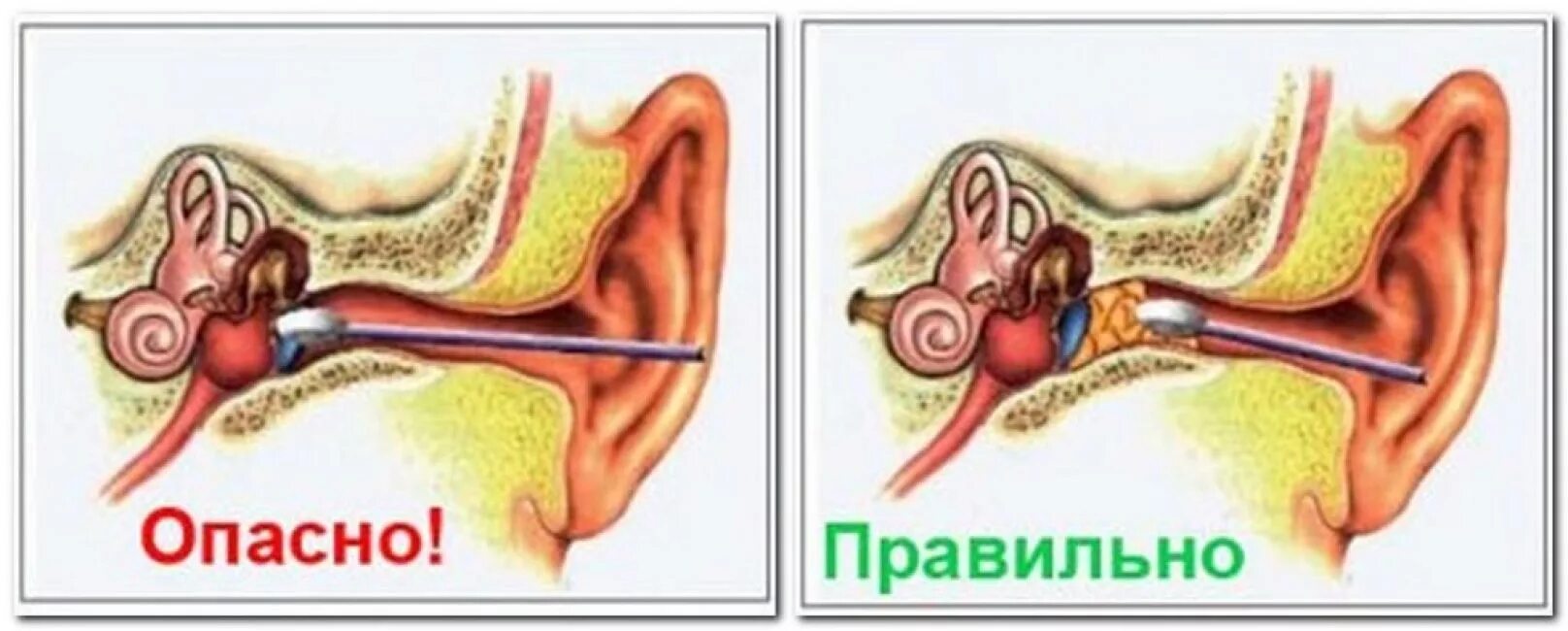 Почему булькает в ухе. Как выглядит ушная пробка.