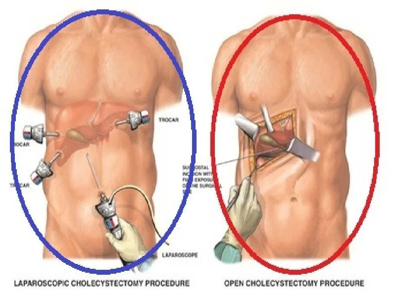 Операция по удалению желчного пузыря анализы. Лапаротомия холецистэктомия. Операция лапароскопическая холецистэктомия. Холецистэктомия желчного пузыря лапароскопическая. Лапароскопия желчного шрамы.