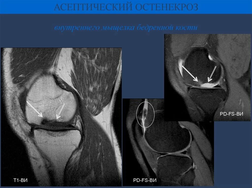 Асептический некроз мыщелка. Асептический некроз коленного сустава мрт. Асептический некроз коленного сустава кт. Асептический некроз мыщелка бедренной кости. Асептический некроз мыщелка бедренной кости кт.