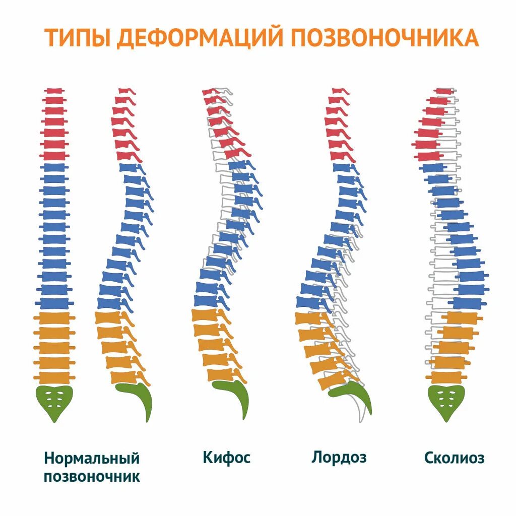 Деформация позвоночных. Деформация позвоночника. типы искривления позвоночника. патологические искривления позвоночника. клиновидный позвонок грудного отдела.