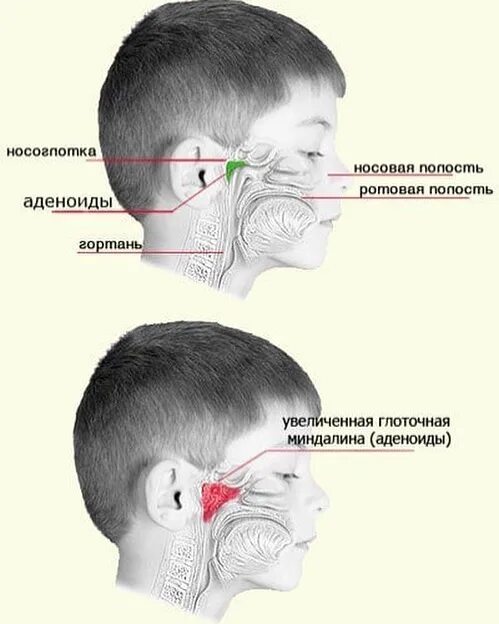 Аденоиды признаки. Аденоиды аденоидные вегетации. Анатомия носоглотки аденоиды. Аденоиды у детей симптомы.