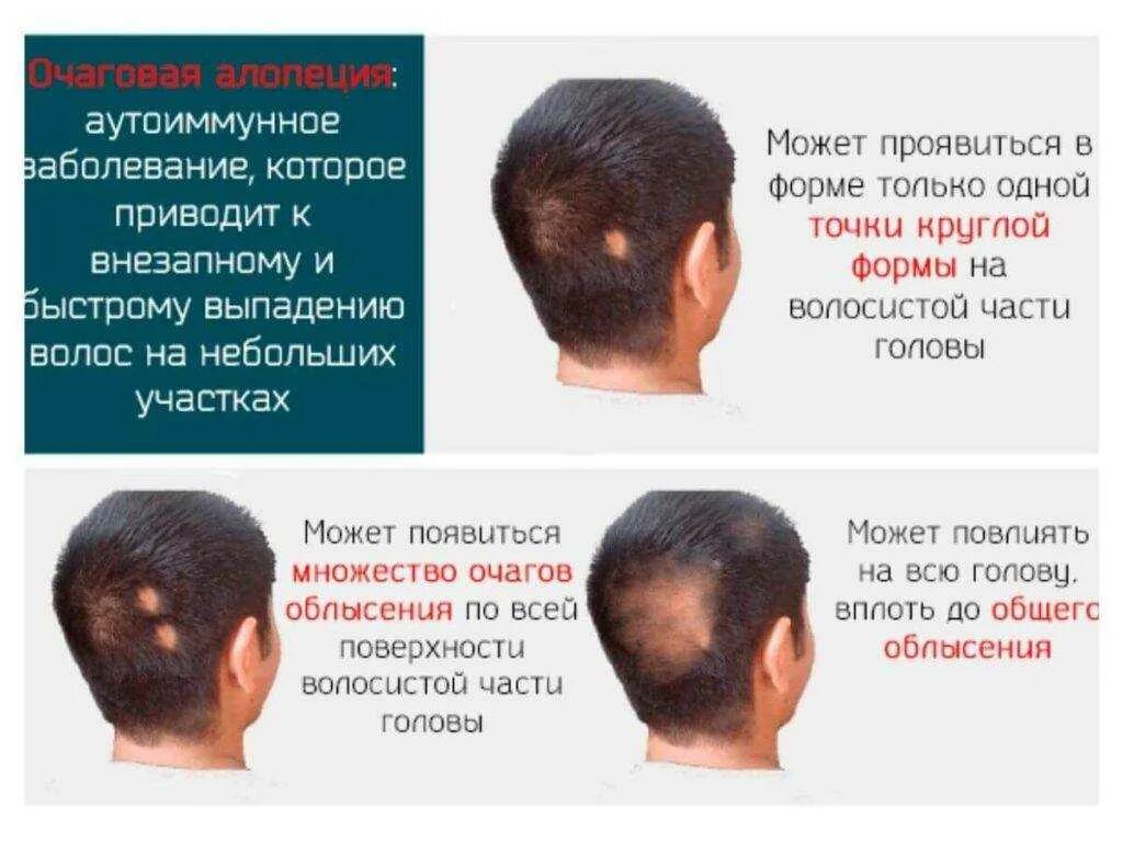 Выпали с головы сон