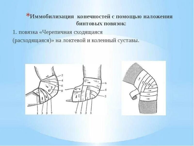 Черепашья расходящаяся на локтевой сустав. Черепашья сходящаяся повязка на локтевой. сходящаяся черепашья повязка на коленный. восьмиобразная повязка. бинтовые повязки.