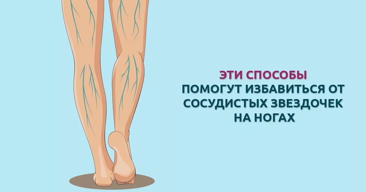 Как избавиться от сеточек. От сосудистых звездочек на ногах. как избавиться от звездочек на ногах. убирание звездочек на ногах.