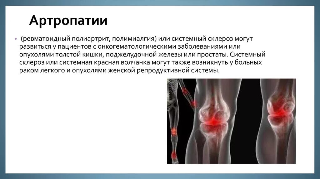 Болезнь депонирования кристаллов пирофосфата кальция. Псориатический артрит критерии диагностики. Симптом артропатии. Симптом артропатии. Симптом артропатии.