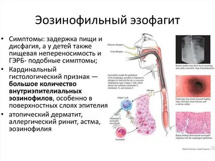 Хронический эзофагит симптомы