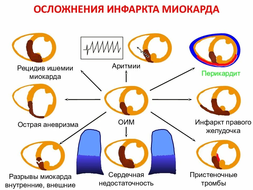 Осложнения острого инфаркта миокарда классификация. Ранние осложнения инфаркта миокарда. Осложнения острейшего и острого периодов инфаркта. Осложнения ИБС инфаркт миокарда.