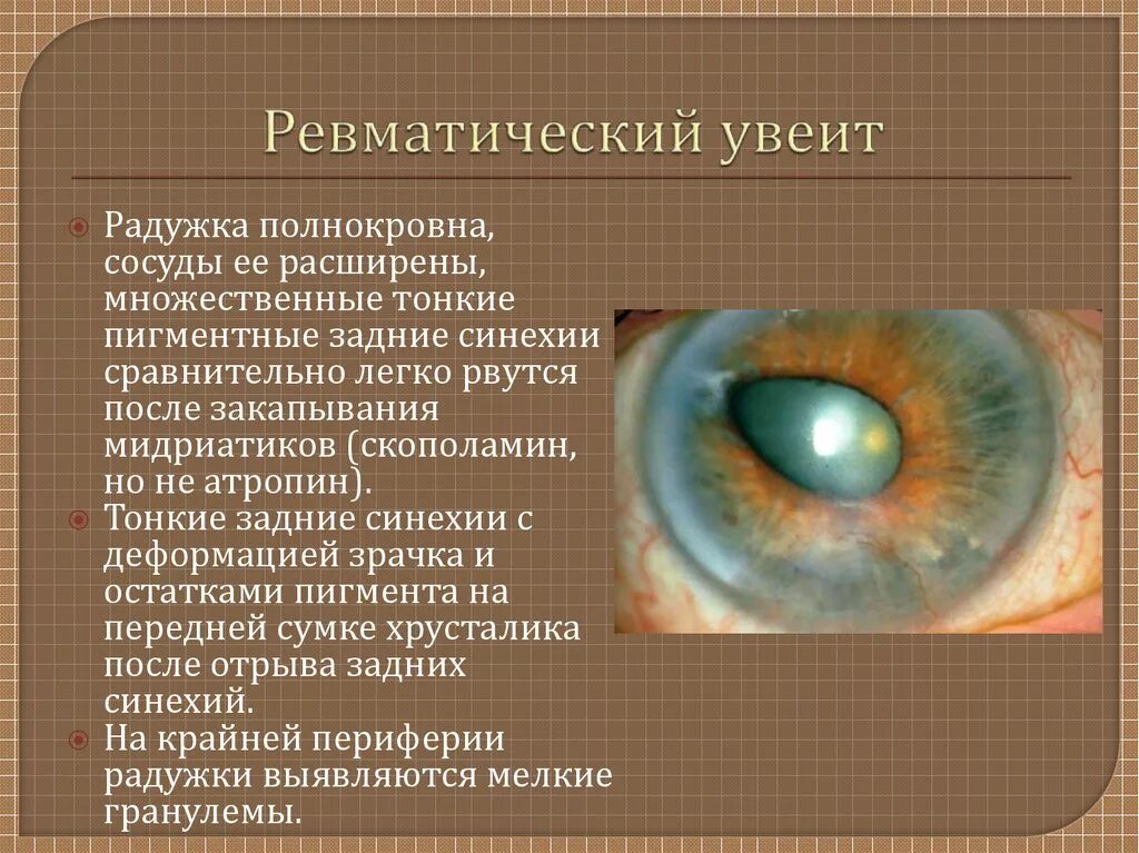 Увеит (воспаление сосудистой оболочки глаза).. Ревматоидный иридоциклит кератит,. Болезни радужки