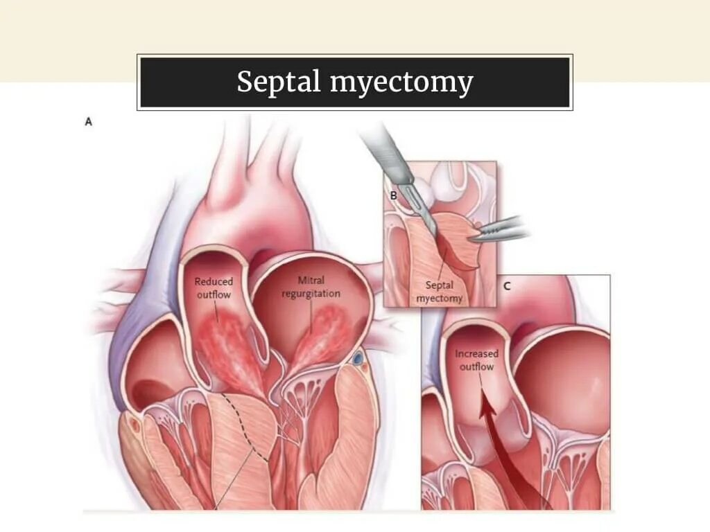 Миоэктомия. Гипертрофическая кардиомиопатия сердца операция. Операции при гипертрофической кардиомиопатии.