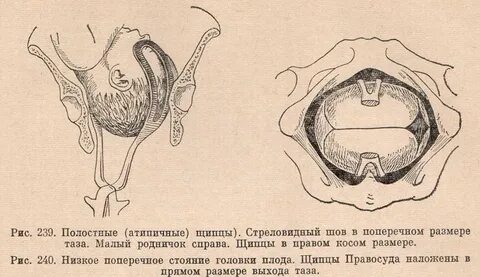 Стреловидный шов в поперечном размере