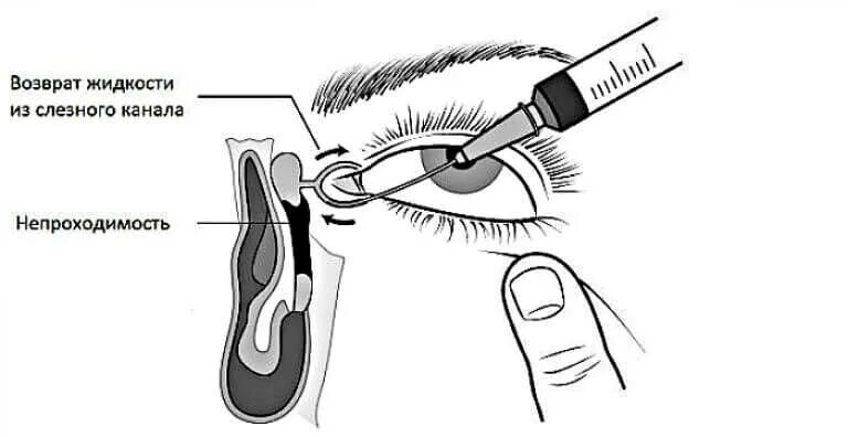 Как прочистить слезные каналы. Зондирование глаза слезного канала. Дакриоцистит промывание слезных путей. Зондирование и промывание слезных путей. Инструменты для зондирования слезных путей.