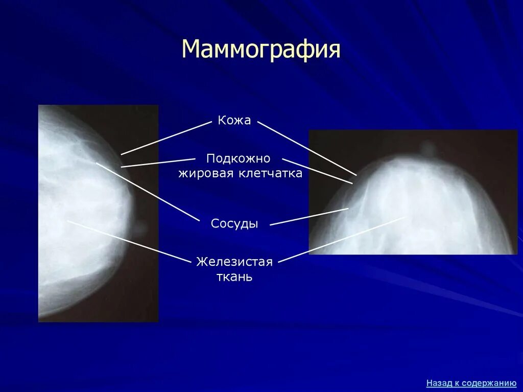 Молочная железа в норме маммография. Рентгеновская маммография молочная железа в норме. Маммография молочных желез bi-rads 5 снимок. Доброкачественные образования молочных желез. Норма молочной железы маммограмма.