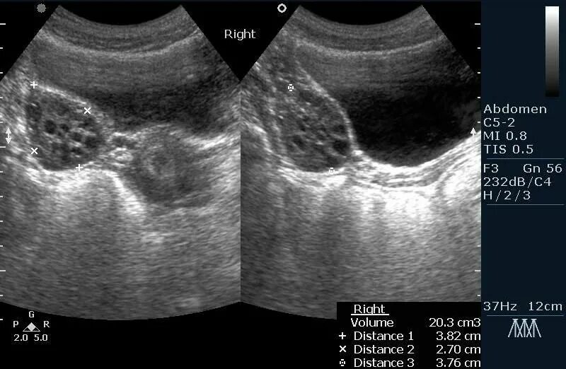 узи придатков у женщин. узи у гинеколога. малый таз узи трансабдоминальное. заключение узи после экстирпации матки с придатками. малый таз узи.