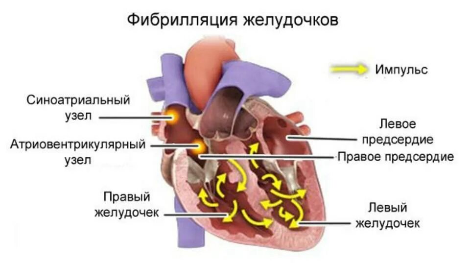 Чем отличается предсердие от желудочка. Фибрилляция желудочков механизм развития. Механизм возникновения трепетания желудочков. Фибрилляция желудочков патогенез. Механизм мерцания желудочков.