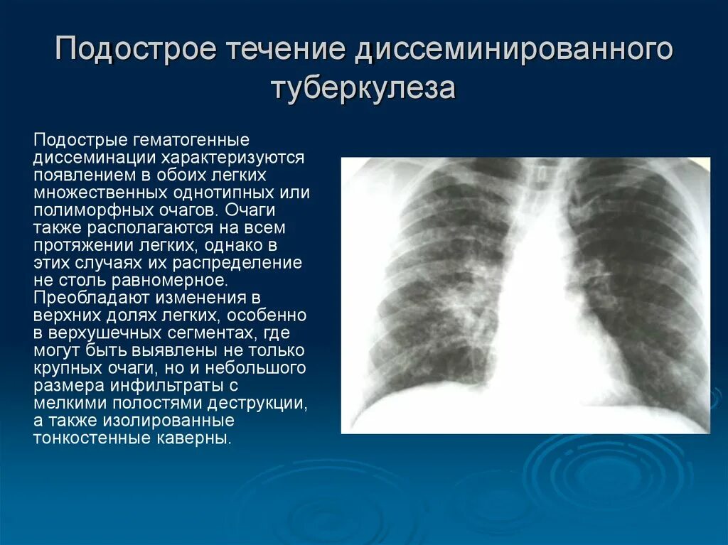 Подострый диссеминированный туберкулез рентген. Лимфогенно диссеминированный туберкулез рентген. Диссеминированный туберкулез легких рентген картина. Милиарный диссеминированный туберкулез рентген. Очаговых изменений правого легкого