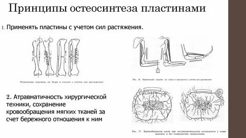 Остеосинтез классификация
