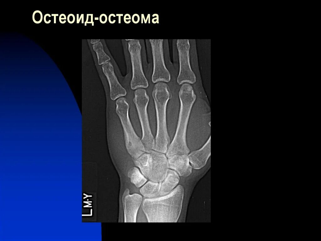 Рентген диагностика переломов трубчатых костей. Классификация переломов по плоскости излома. Диагностика перелома трубчатых костей. Типы переломов по линии излома. Диагностика перелома трубчатых костей.