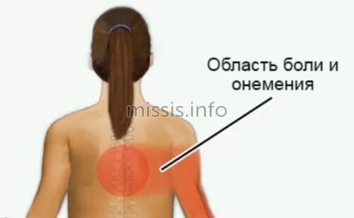 Остеохондроз грудного отдела. Боль при остеохондрозе грудного отдела. Локализация боли при грудном остеохондрозе. Боли при грудном остеохондрозе у женщин.