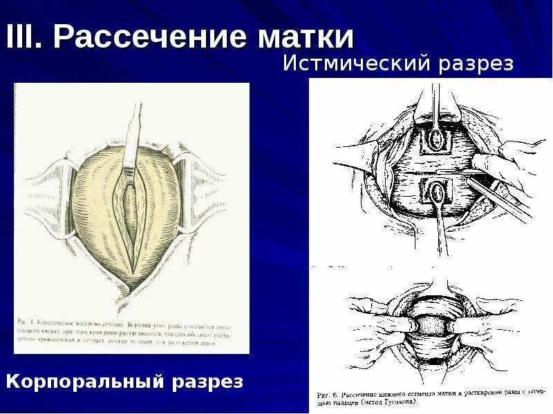 Рассечение термин