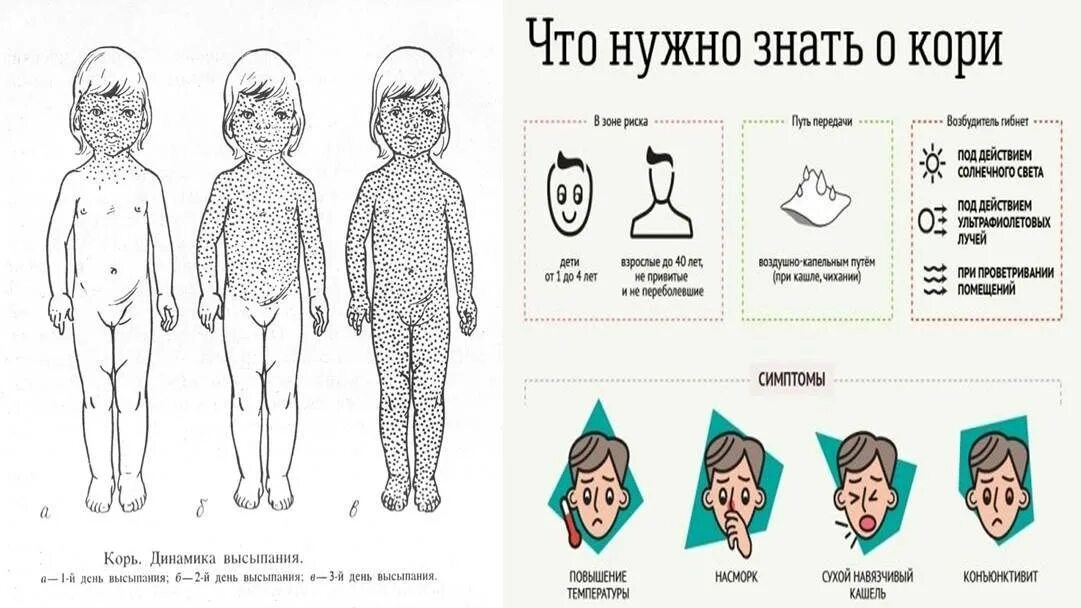 Корь и краснуха различия в сыпи. Сыпь корь краснуха сыпь. Корь краснуха симптомы у детей. Корь у детей у детей клинические рекомендации. Сыпь отличия