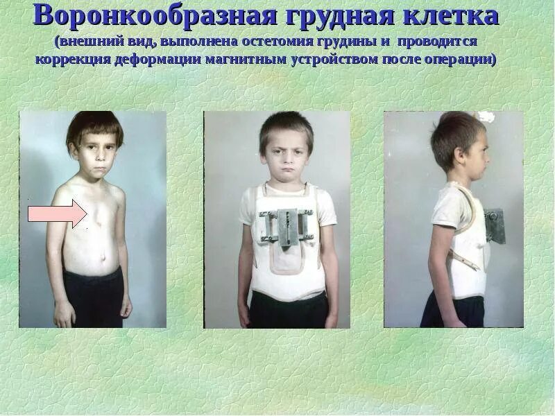 Воронкообразная Грудь Фото